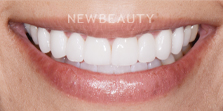 Dr. Nathan Hoffman - Smile Makeover - After