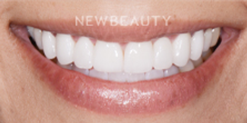 Dr. Nathan Hoffman - Smile Makeover - After