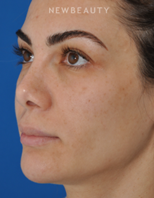Dr. Edward Kwak - Revision Rhinoplasty - Before