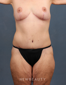 Dr. Chet Mays - Tummy Tuck - After