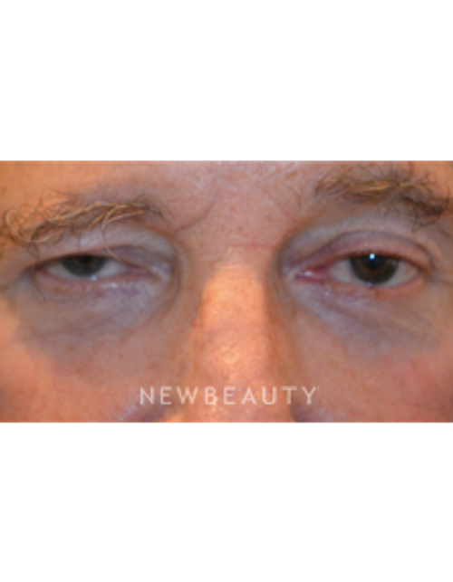 Dr. B. Aviva Preminger - Natural-Looking Results - After