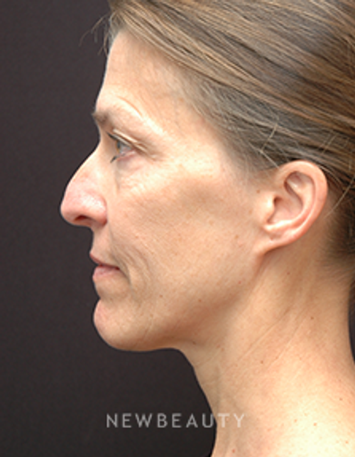 Dr. Jeffrey B. Wise - Rhinoplasty - Before