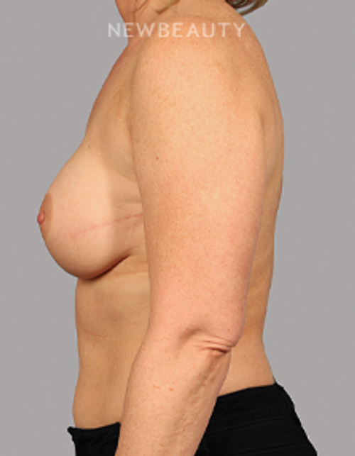 Dr. Kurtovic - Breast Reconstruction - 20637791 - After