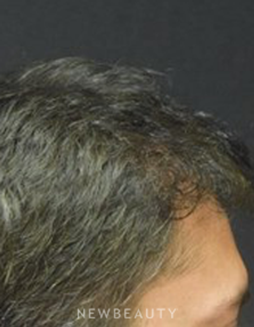 Dr. Jeffrey B. Wise - Hair Transplant - After