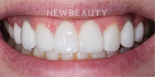 Dr. Nathan Hoffman - Dental Implants - After