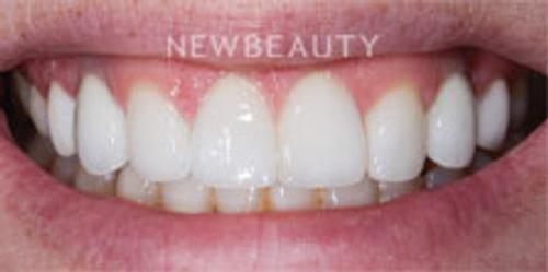 Dr. Nathan Hoffman - Dental Implants - After