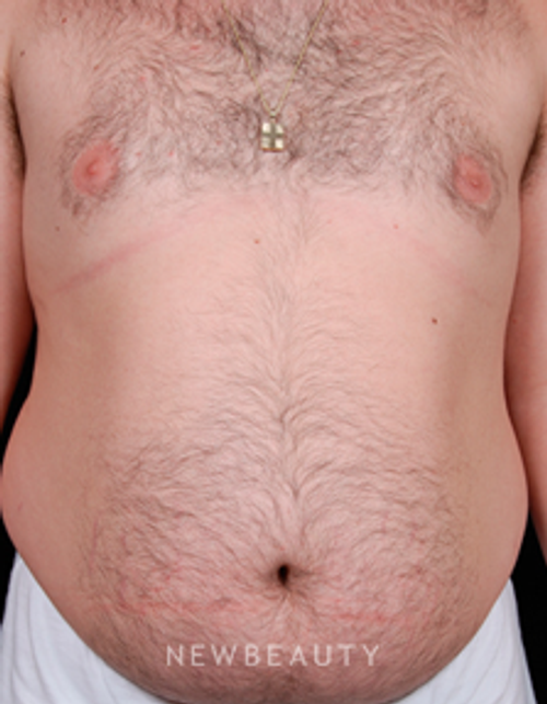 Dr. Steven Bloch Liposuction, Tummy Tuck - Before