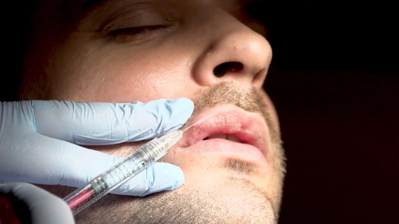 What It Was Like To Get Lip Fillers For The First Time