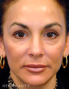 Dr. Kelly Bomer Rhinoplasty - Before