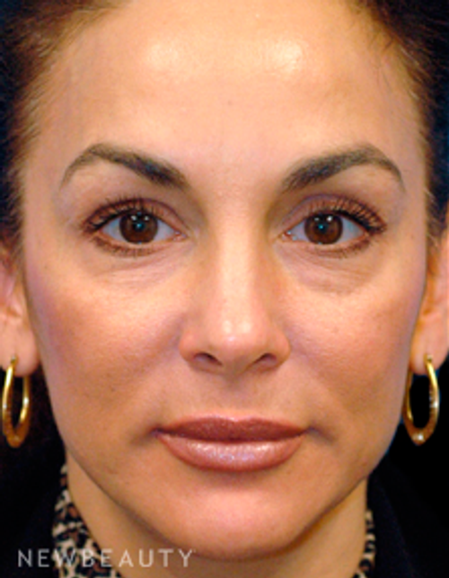 Dr. Kelly Bomer Rhinoplasty - Before