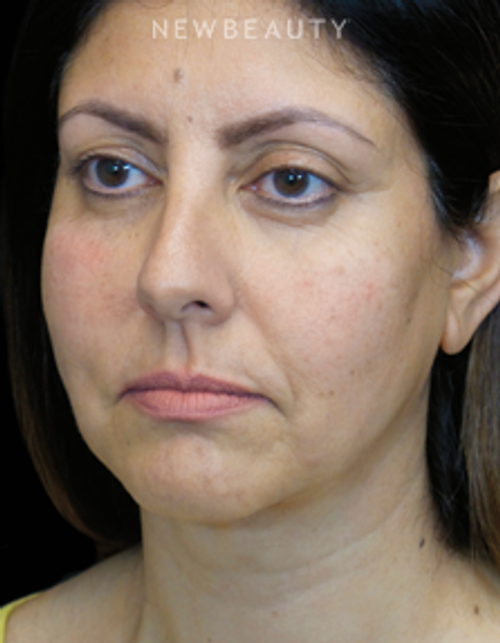 Dr. Adam Summers - Facelift - After