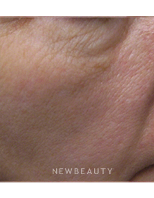 Dr. Kally Papantoniou - Laser Resurfacing - Before