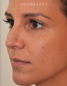 Dr. Edward Kwak - Rhinoplasty - After