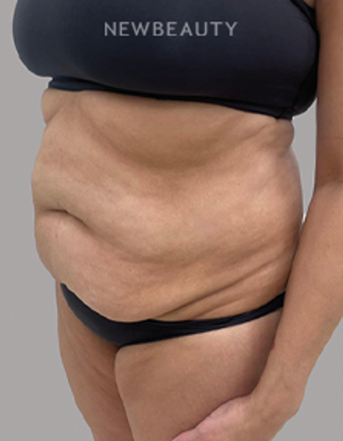 Dr.Drew Schnitt - Abdominoplasty - 46167716 - Before
