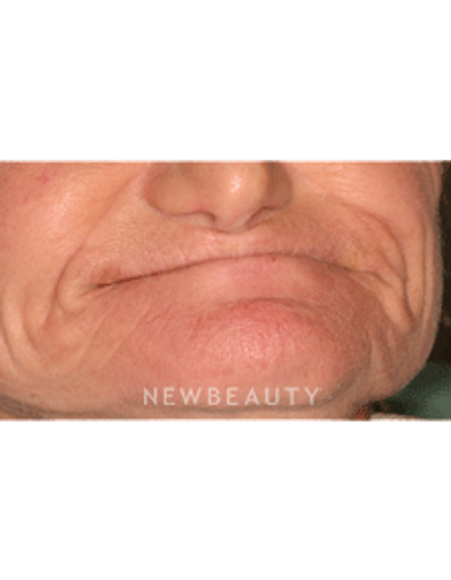 Dr. Neal Patel Smile Makeover - Before