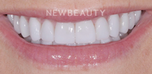Dr. Salvator La Mastra - Smile Makeover -46107373 - After