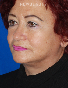 Dr. Konstantin Vasyukevich - Lower Facelift - After