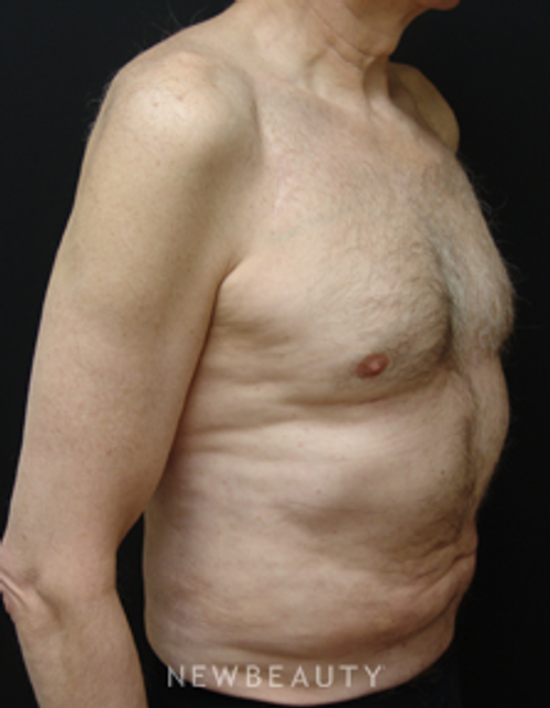 Dr. Mokhtar Asaadi Liposuction - After