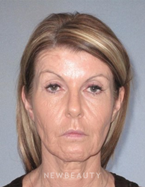 Dr. German Newall - Lower Bleph - Before