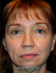 Dr. Kelly Bomer Liquid Facelift - Before