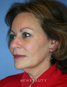 Dr Kelly V. Bomer Liquid Facelift - After