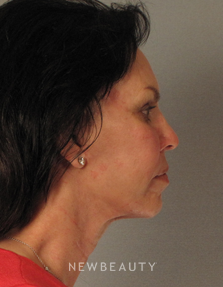 Dr. Mentz, Facelift & Necklift - After