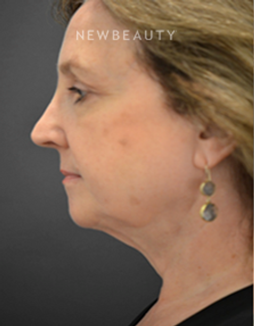 Dr. B. Aviva Preminger- Smartlipo - After
