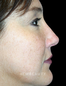 Dr. Kelly Bomer Rhinoplasty - After