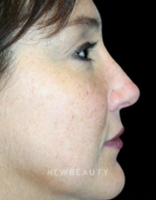 Dr. Kelly Bomer Rhinoplasty - After