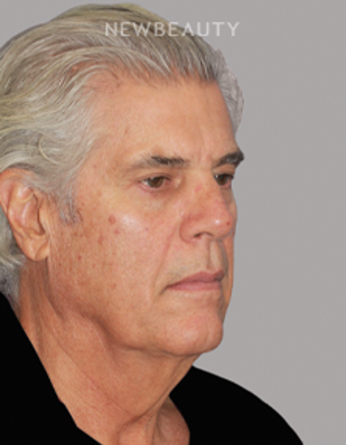 Dr. Konstantin Vasyukevich – Deep Plane Face and Neck Lift – 46903643 - Before