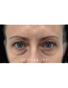 Dr. Julie Russak Injectables & Fillers - Before