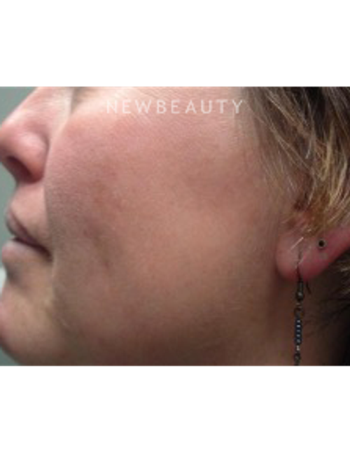 Dr. Marina Peredo - Lasers - After