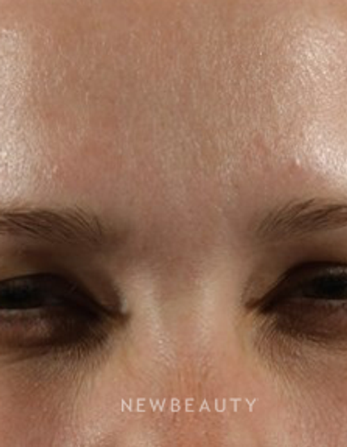Dr. Marina Peredo - Botox - After