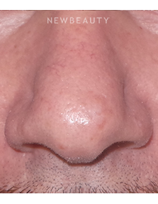 Dr. Sean Simon - Lasers - After