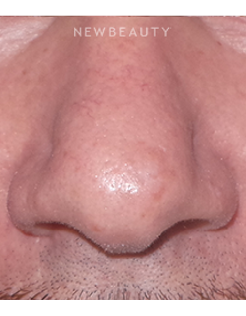Dr. Sean Simon - Lasers - After