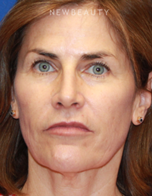 Dr. Dilip Madnani - Facelift - Before