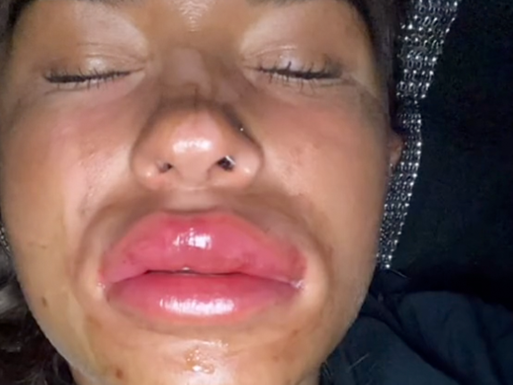 This Viral Video Showcases the Danger of  Drinking After Getting Lip Filler