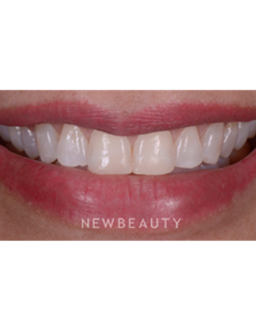 Dr. Husam Almunajed - Smile Makeover - Before