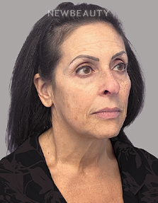 Dr. Dilip Madnani - Facelift - 45283915 - Before