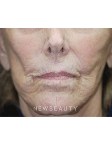 Dr. Kenneth Beer Lasers - After