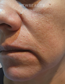 Dr. Anna Chacon - Melasma - 34291235 - After