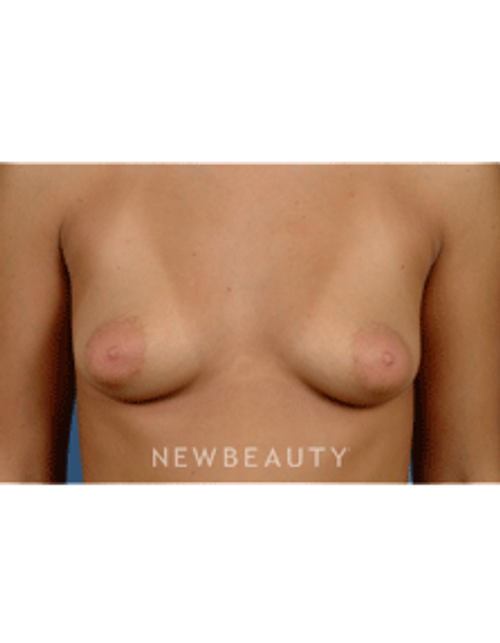 Dr. Bradley Calobrace Breast Augmentation - Before