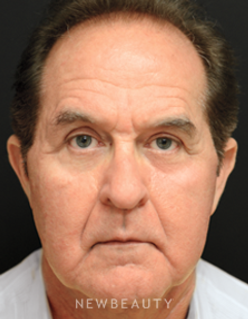 Dr. Mokhtar Asaadi, Blepharoplasty, Traditional Facelift - After