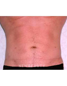 Dr. Roman Rayham - Sculpted Look - After