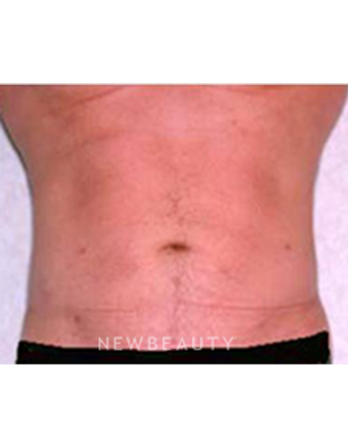 Dr. Roman Rayham - Sculpted Look - After