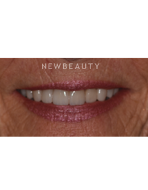 Dr. Sara Cummins - Smile Makeover - After