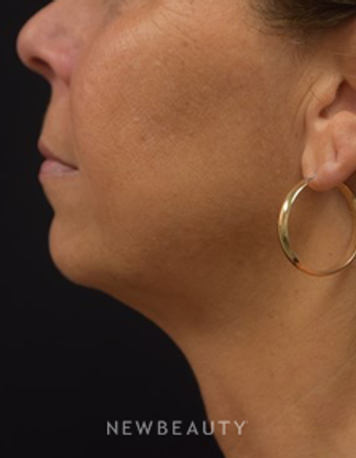 Dr. Jeffrey B. Wise - Ultherapy & Juvederm - After