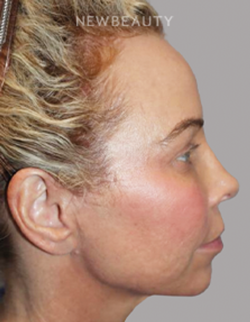 Dr. Sanjay Grover - Rhinoplasty - 49727892 - After
