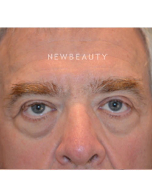 Dr. B. Aviva Preminger - Rejuvenated Eyes - Before