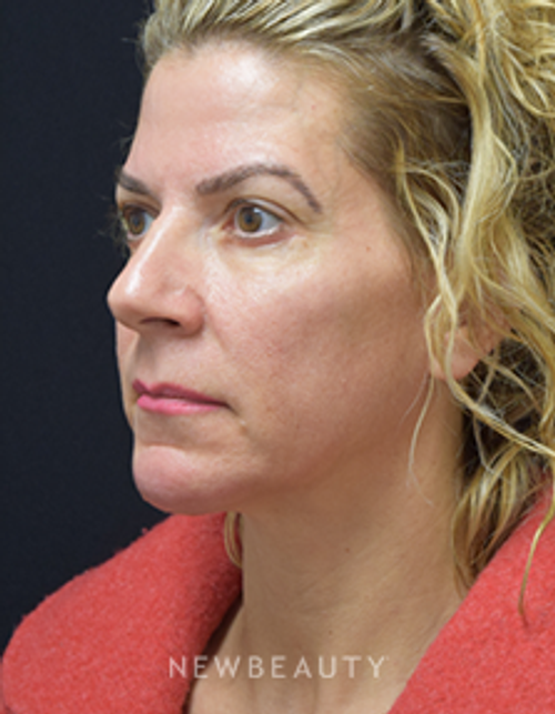 Dr. Jeffrey B. Wise - Chin Implant - After